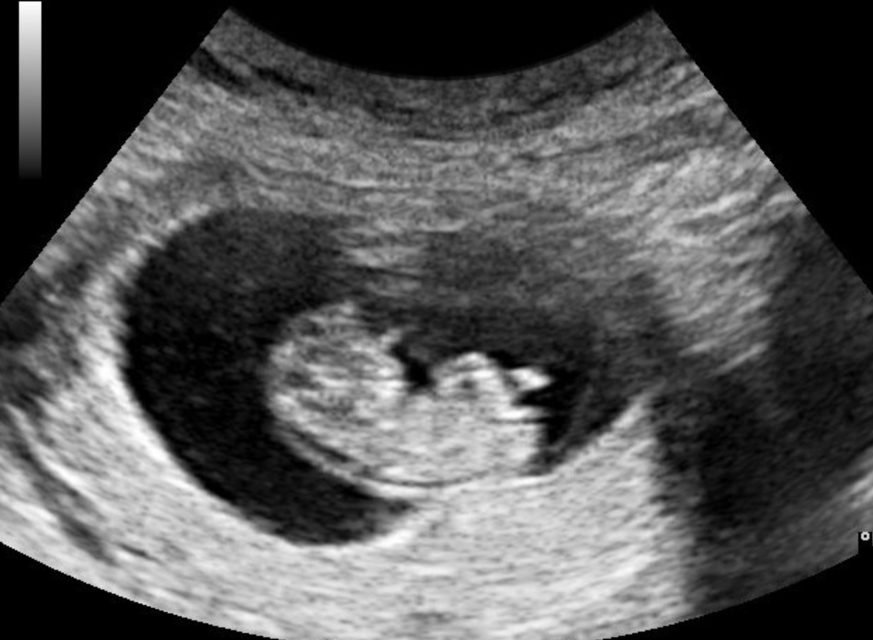 8 неделя беременности месячные. УЗИ 3 месяца беременности. УЗИ ребенка на 3 месяце беременности. УЗИ 2 месяца беременности. Фото УЗИ беременности 3 месяца плода.